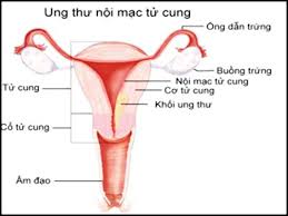 Viêm nội mạc tử cung - Hình ảnh minh họa